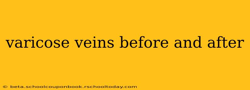varicose veins before and after